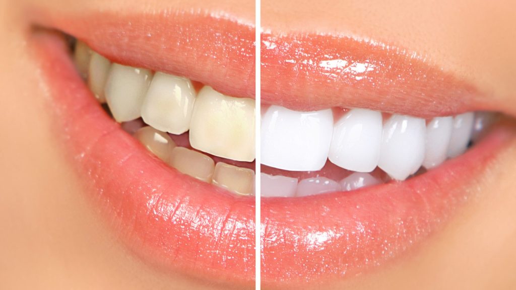 Yellow teeth whitened by Portage MI cosmetic dentist