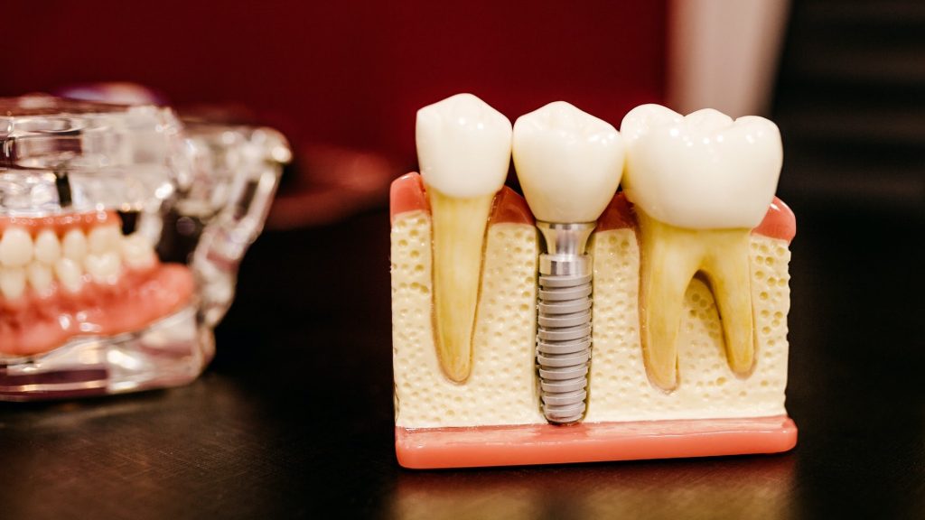 Dental Implant Dentist In Portage MI