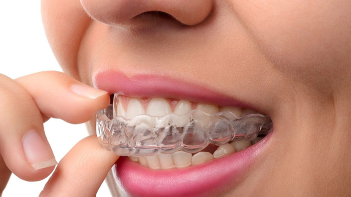 Invisalign Aligners Dentist Portage Mi Invisalign Near Me